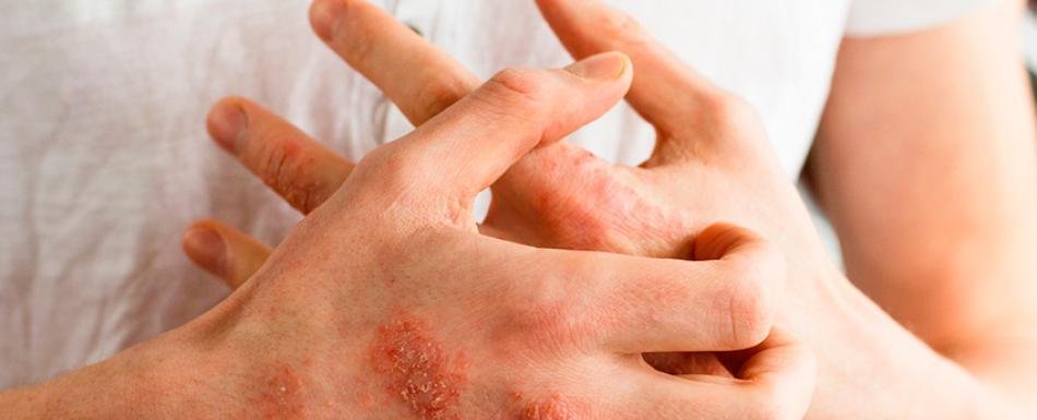 ¿Cómo evitar la dermatitis atópica?
