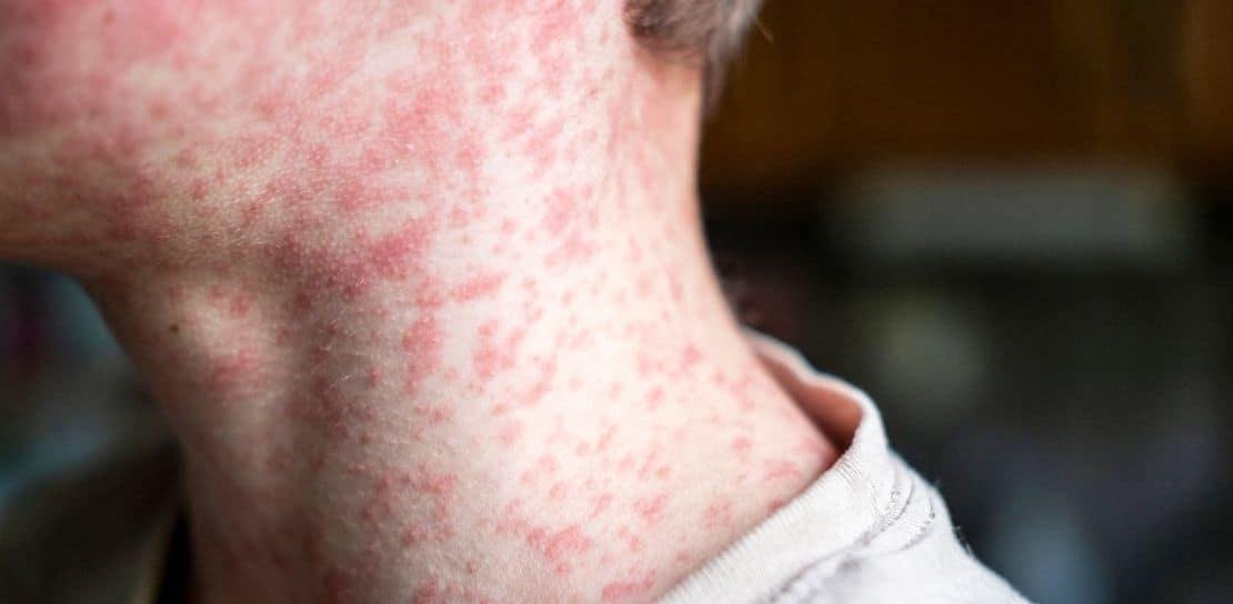 Prohíben visitas al mayor centro de detención de migrantes en EE. UU. por brote de sarampión