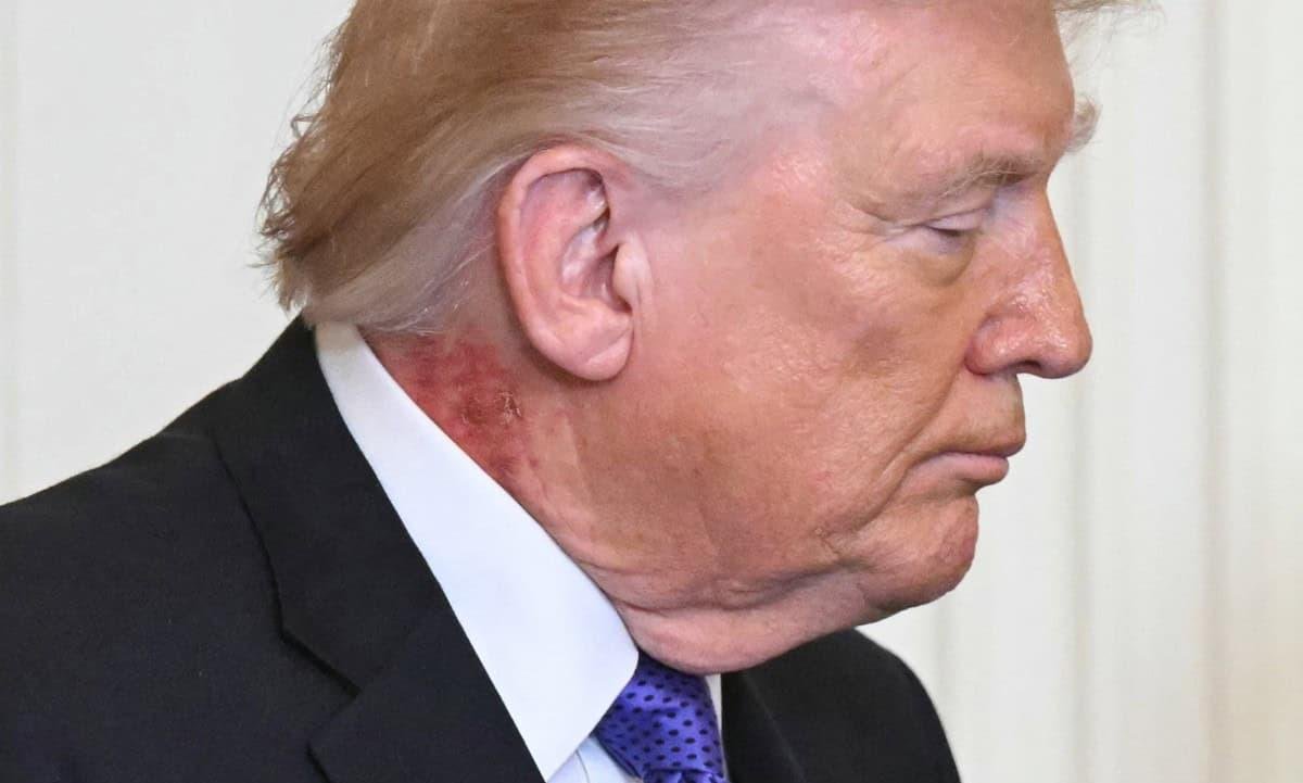 Trump es visto con una gran mancha roja en el cuello