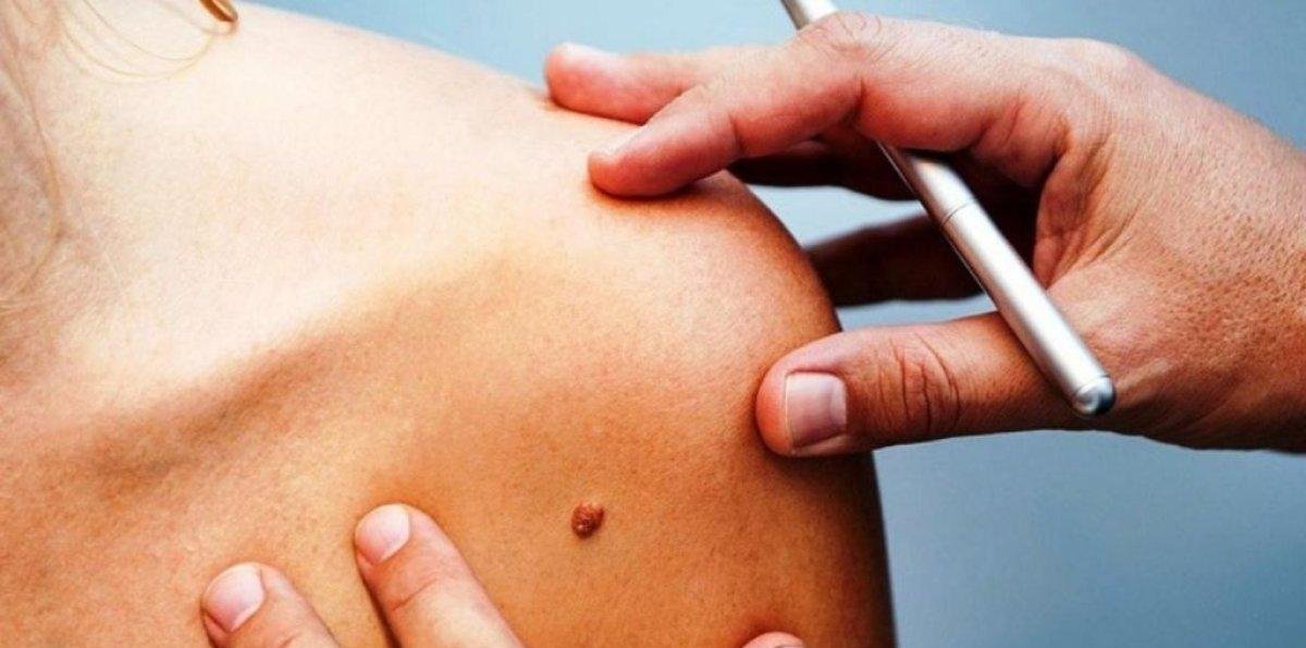 Día Mundial contra VPH, un virus que muchos contraen sin saberlo: ¿Qué es y cómo prevenir?