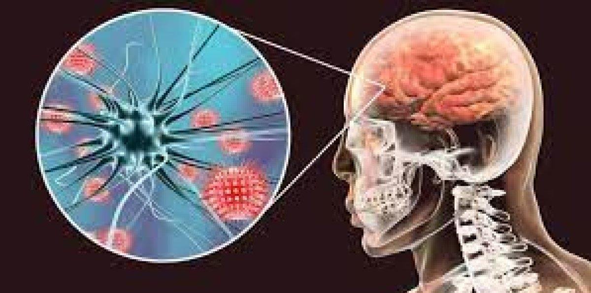 Meningitis: síntomas, causas y cuándo acudir al médico