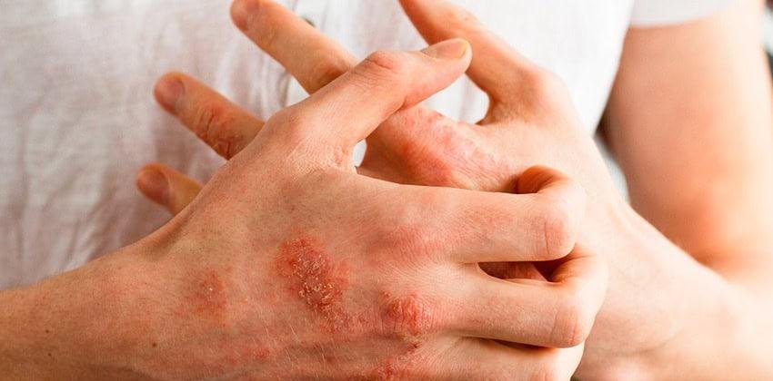 Dermatitis atópica, cómo evitarla