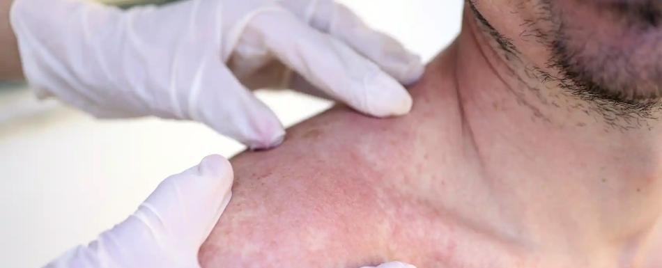 Una de cada cinco personas desarrollará algún tipo de cáncer de piel, estiman los expertos