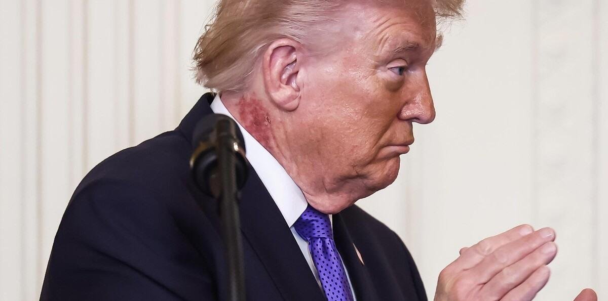 Trump luce un sarpullido en el cuello, que su médico atribuye a un tratamiento preventivo