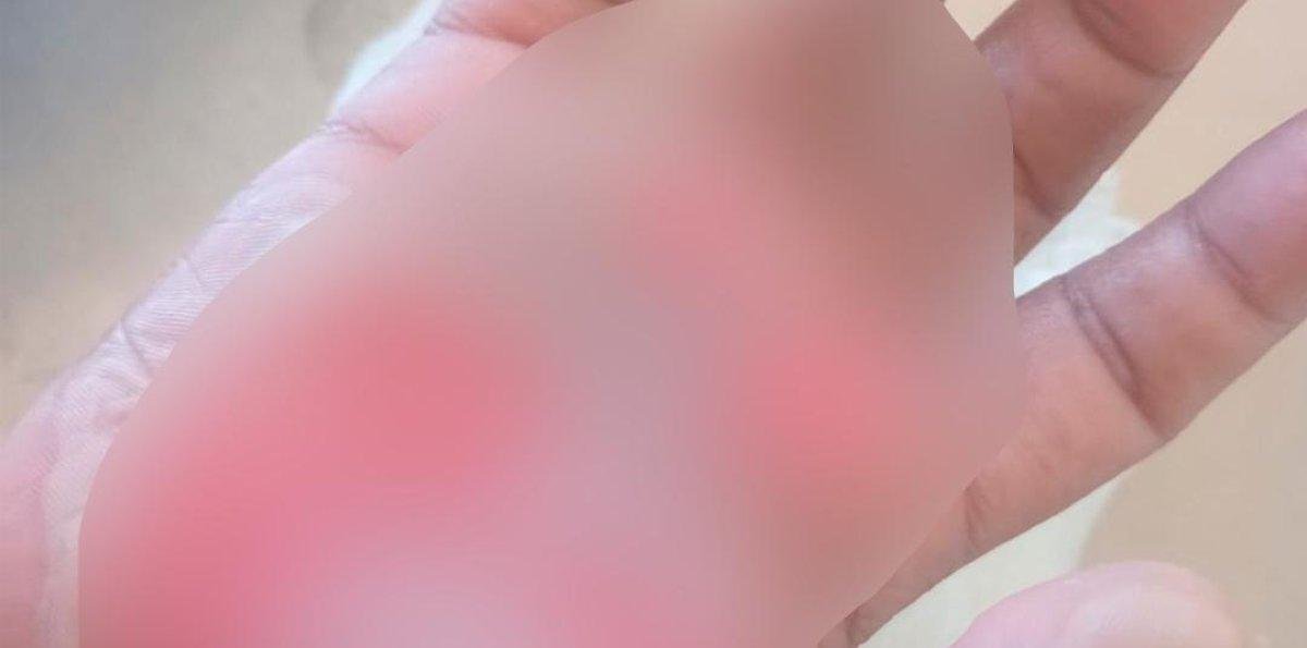 Cómo evoluciona la salud de la niña a la que le quemaron las manos