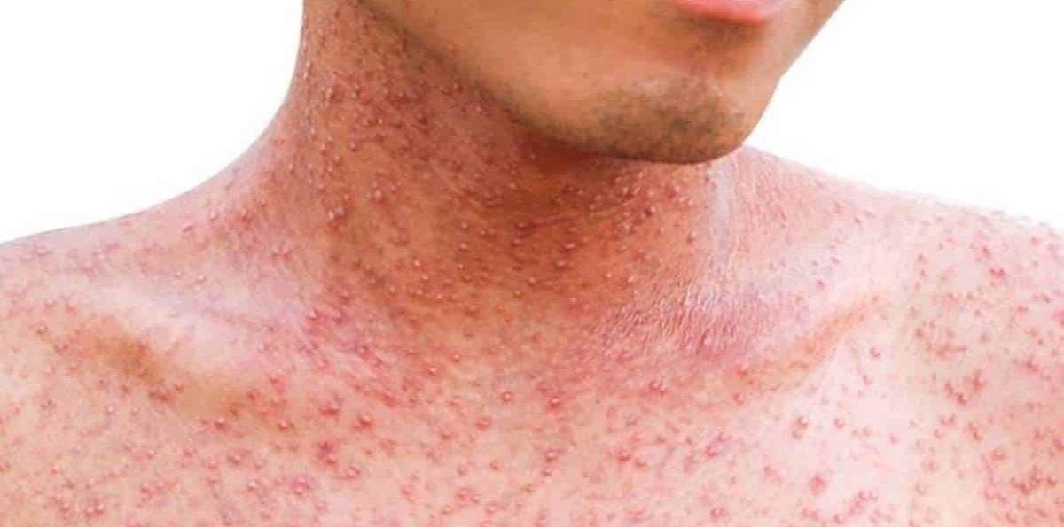 Sarampión: síntomas, cómo se transmite y cómo prevenirlo paso a paso