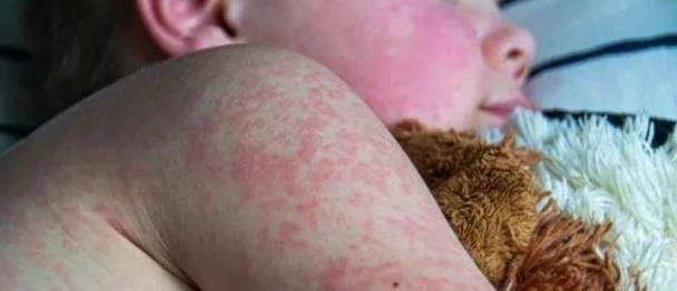 Crece epidemia de sarampión en EE. UU. con aumento de casos en Carolina del Sur