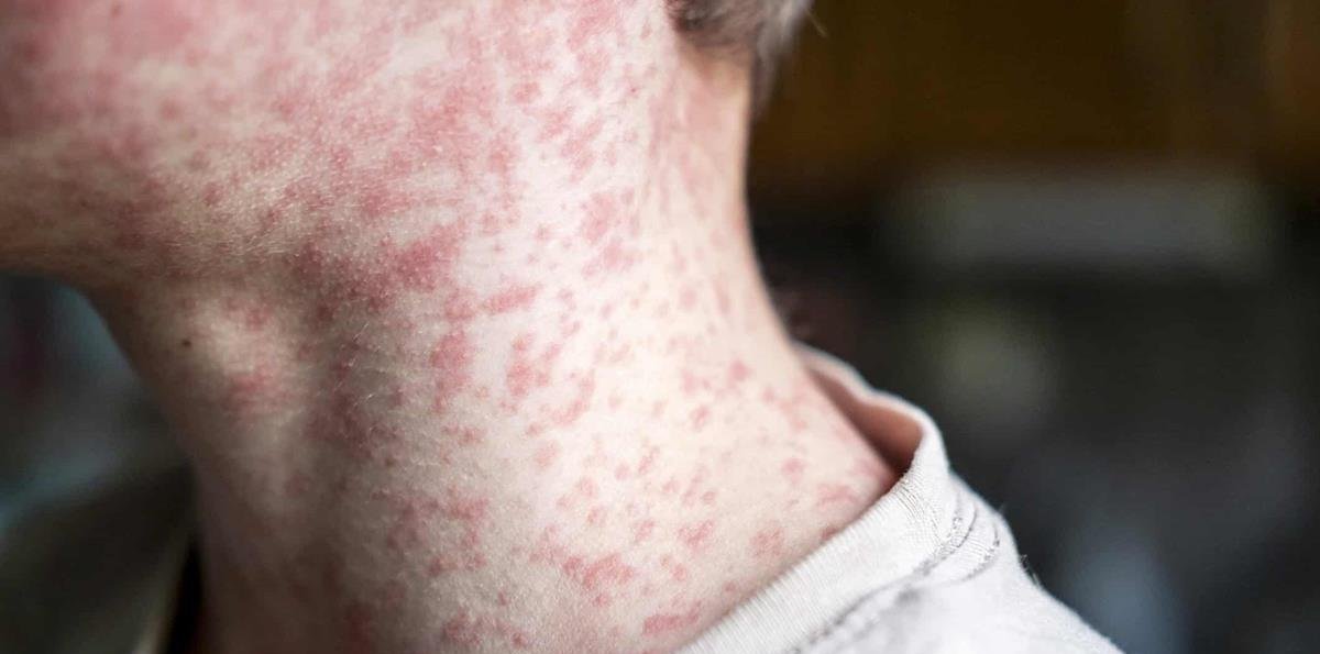 Florida alerta de brotes de sarampión en universidades ante récord del virus en EE. UU.