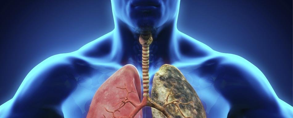 Advierten sobre el aumento de cáncer de pulmón en adultos jóvenes que nunca han fumado