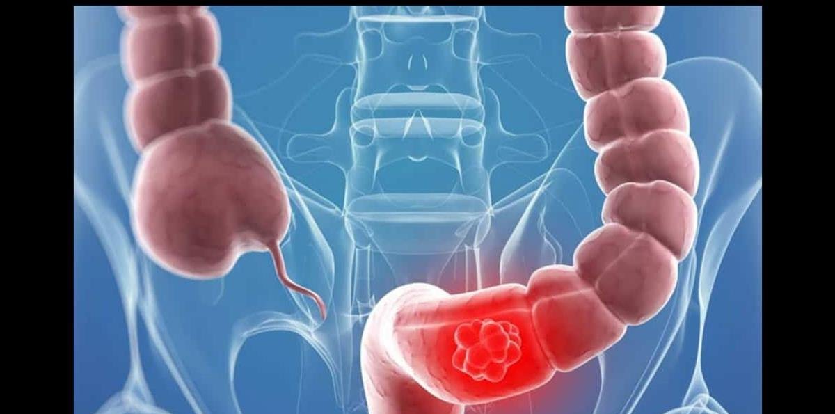 Las causas del aumento del cáncer colorrectal en menores de 50 años siguen sin conocerse